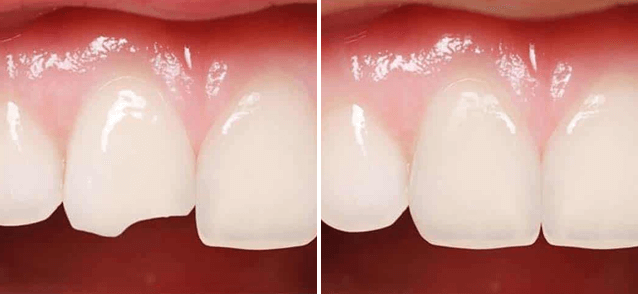 Восстановление сломанного зуба